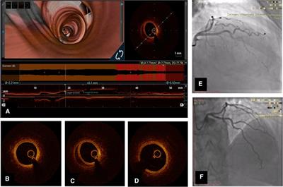 Drugs for spontaneous coronary dissection: a few untrusted options